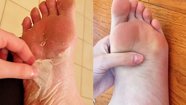 Foot mask peels off dead skin and calluses to reveal baby-soft feet