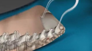 Spine surgery || S world trending video