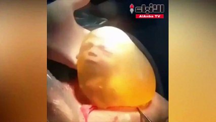 جنين داخل الغشاء الأمنيوسي خارج بطن أمه