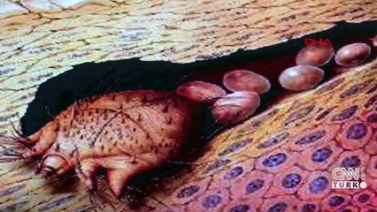 Korona günlerinde "Dirençli uyuz" salgını