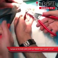 «التدخل السريع» يفك التشابك بين إصبع طفل وقطعة بلاستيكية