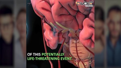 How to spot the warning signs of stroke