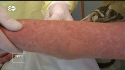 Cara Jerman Cegah Penularan Campak Agar Jangan Jadi Ancaman