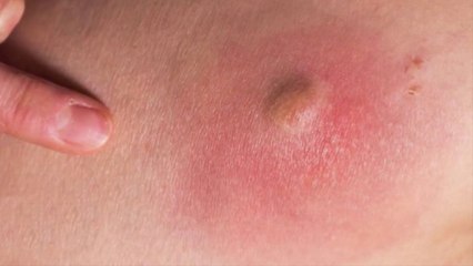 bd-como-se-tratan-los-abscesos-030321