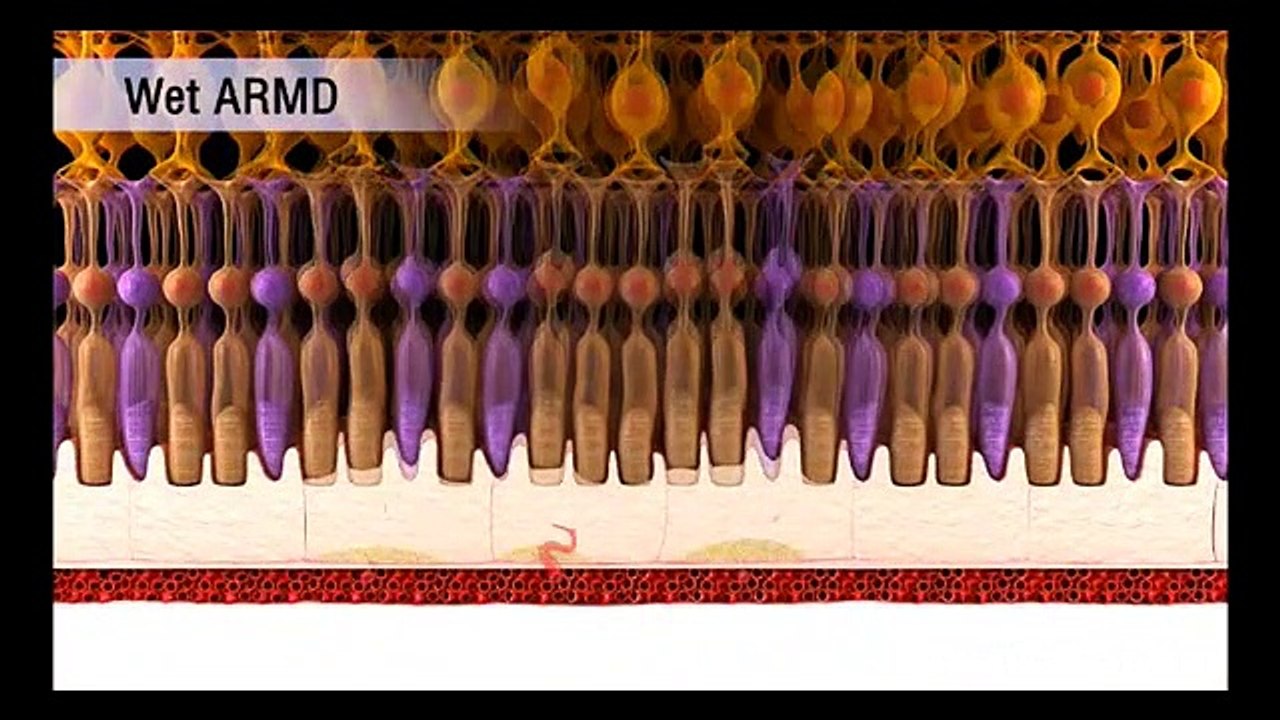 Age Related Macular Degeneration (ARMD) Patient education & information