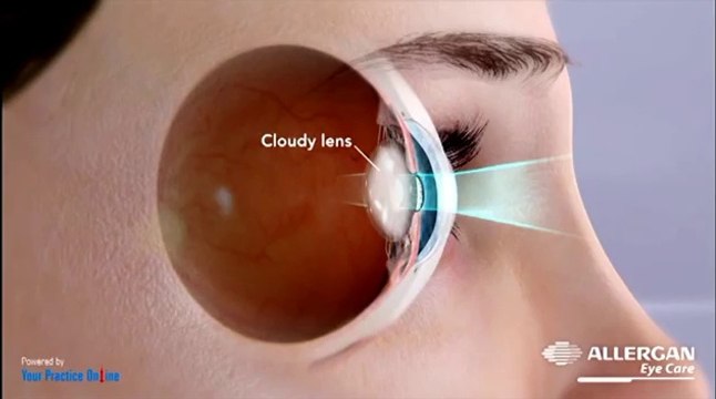 Cataract | Basic education and Information for patients