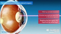 Information about Cataract surgery | Different Methods | Phaco Emulsification | Types of IOL lens implants | post-operative Care