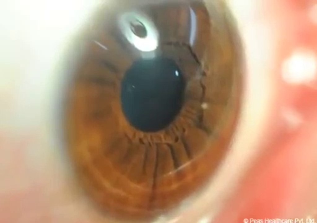 DRY EYE SYNDROME  || हिंदी में  In  HINDI || Education & Information _Causes , Symptoms , Treatment.