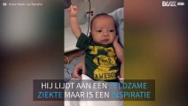 Na drie operaties buigt baby met zeldzame ziekte zijn spieren