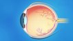 bd-aclaramos-sus-dudas-sobre-el-glaucoma-120321