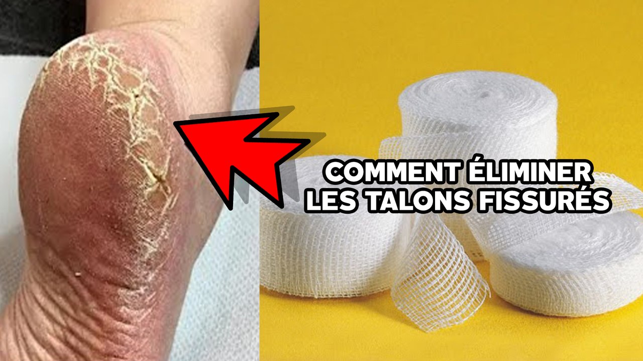 Éliminez les talons fissurés, les cors et les callosités grâce à ce remède de grand-mère