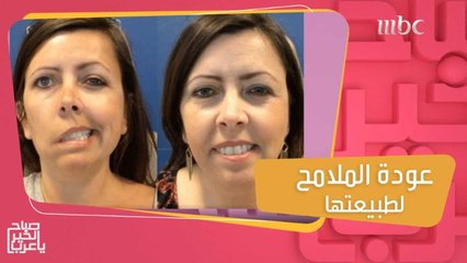 عودة الملامح لطبيعتها أصبحت ممكنة عبر طريقة معالجة تلف أعصاب الوجه وانحراف ابتسامة الفم بـ "الفيلر والبوتوكس"