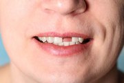 Qual os danos para saúde quando se perde dentes, Odontólogo responde