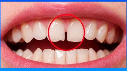 bd-espacios-interdentales-caracteristicas-y-como-tratarlos-160321