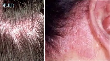 Conoce tu piel | Dermatitis seborreica - Nex Panamá