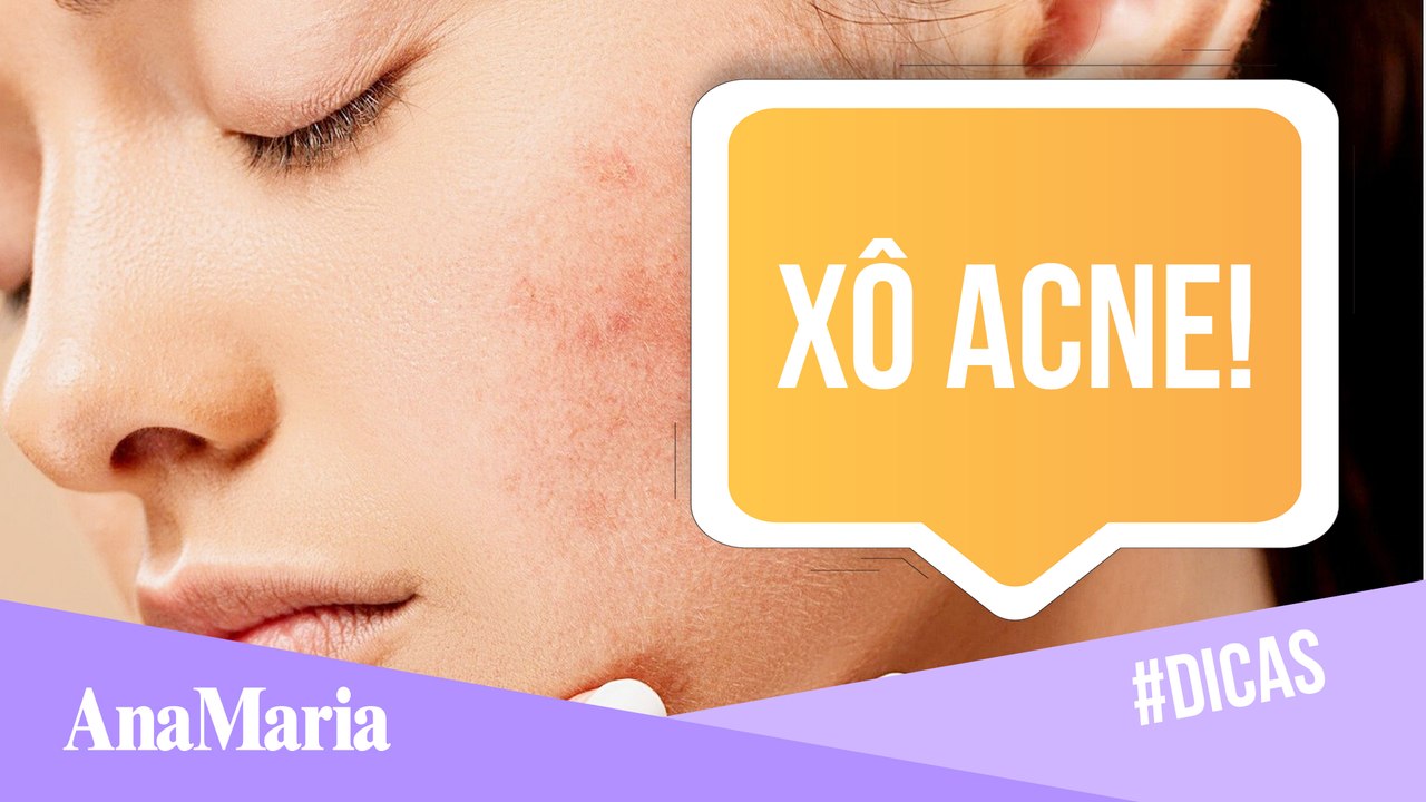 5 DICAS PARA CUIDAR DA ACNE!