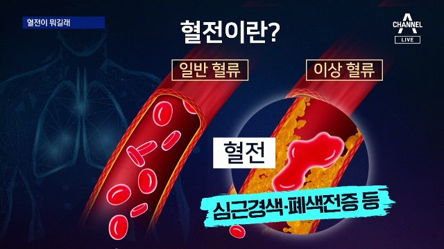 혈전 발생 국내 2번째…아스트라제네카 어떻게 될까