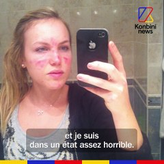 Dermatillomanie : un trouble peu connu | Le Speech de Camille Montaz