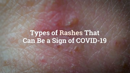 Descargar video: 8 Types of Rashes That Can Be a Sign of COVID-19