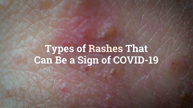 8 Types of Rashes That Can Be a Sign of COVID-19