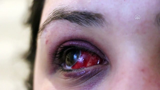 KARABÜK - Bir kadın kendisini darbettiği iddiasıyla avukat erkek arkadaşından şikayetçi oldu