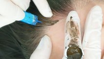 Hairline microblading gives the appearance of fuller hair
