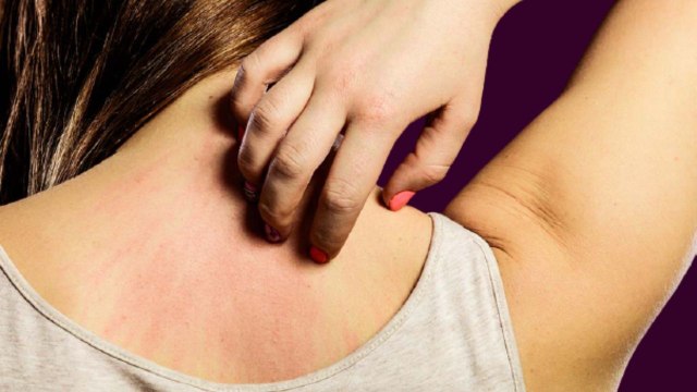 गर्मी में खुजली की दिक्कत से निजात पाने के लिए अपनाएं ये घरेलू तरीके।Remedies to get rid of itching