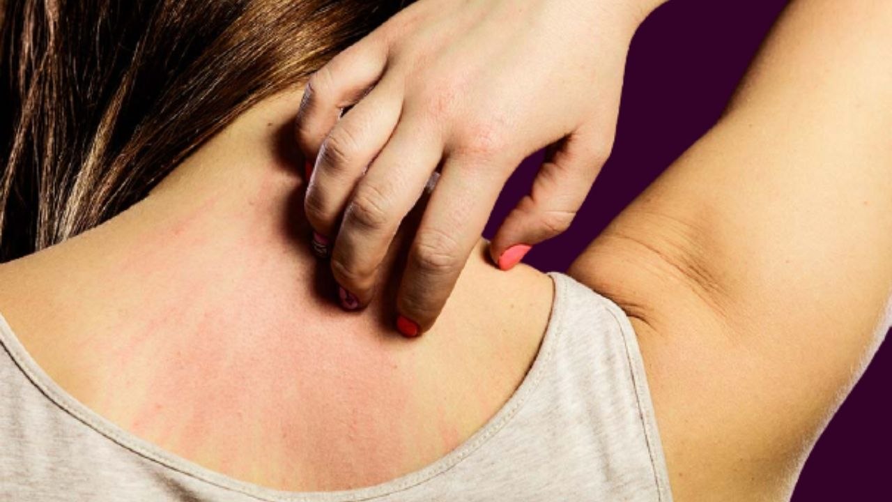गर्मी में खुजली की दिक्कत से निजात पाने के लिए अपनाएं ये घरेलू तरीके।Remedies to get rid of itching