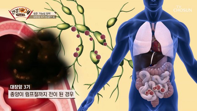‘대장암 4기’ 투병 중에도 포기할 수 없었던 노래.. TV CHOSUN 210322 방송