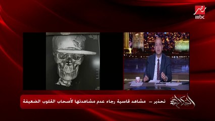 د. حسان النعماني عضو الفريق الطبي الذي أخرج الساطور من رأس سيدة بنجاح يحكي تفاصيل إنقاذ الضحية في عملية ٧ ساعات