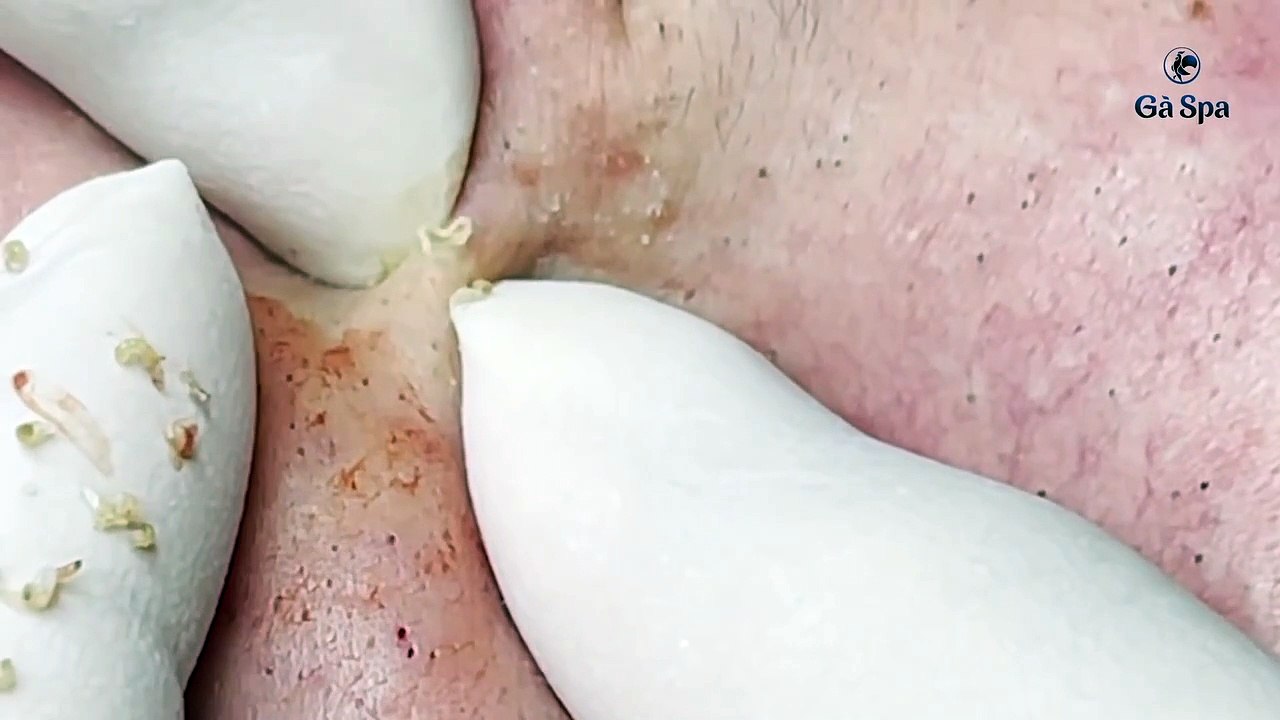 Big Cystic Acne Blackheads Extraction Blackheads & Milia, Whiteheads Removal Pimple Popping S004