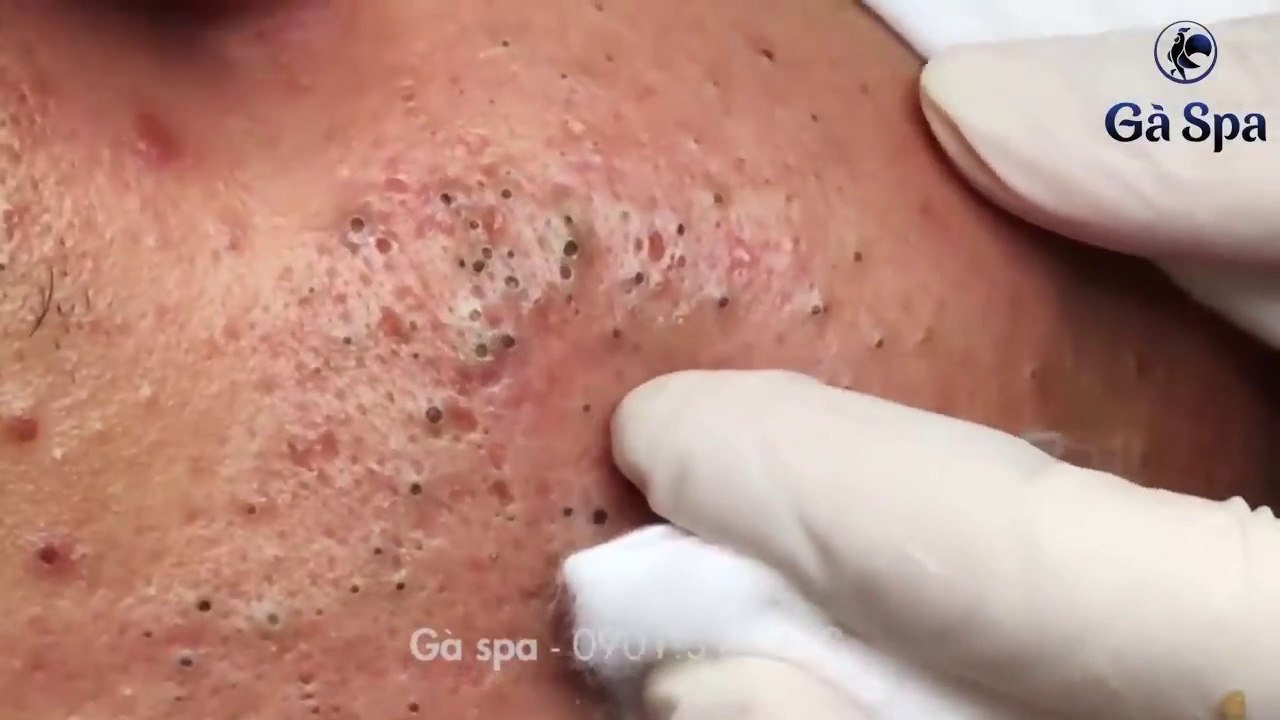 Big Cystic Acne Blackheads Extraction Blackhead...