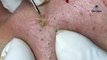 Big Cystic Acne Blackheads Extraction Blackheads & Milia, Whiteheads Removal Pimple Popping S006