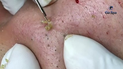 Big Cystic Acne Blackheads Extraction Blackheads & Milia, Whiteheads Removal Pimple Popping S006
