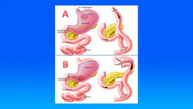 bd-cancer-de-estomago-230321