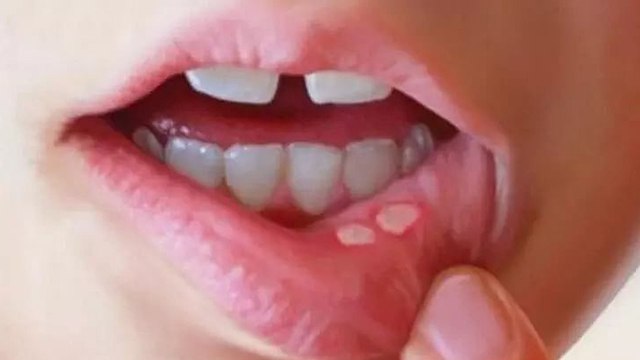 मुंह में छाले होने पर खाएं इन चीजों को जल्द मिलेगी राहत । Eat This Things In Mouth Ulcer । Boldsky