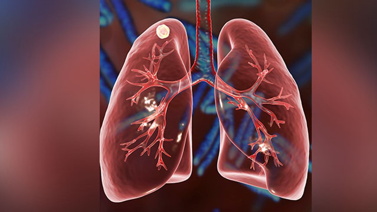 World Tuberculosis Day 2021: टीबी रोग के इलाज क...