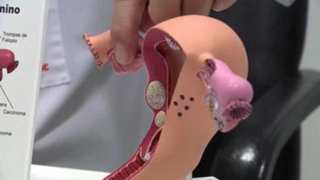 En España alrededor de 2.000 mujeres al año son diagnosticadas de cáncer de cérvix