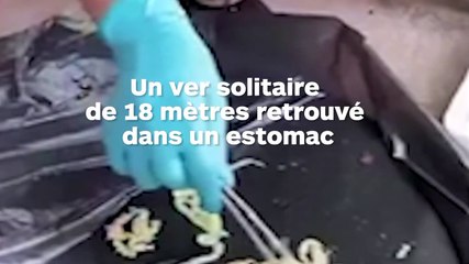 Un ver solitaire de 18 mètres vivait dans son estomac