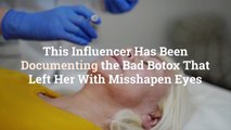 This Influencer Has Been Documenting the Bad Botox That Left Her With Misshapen Eyes