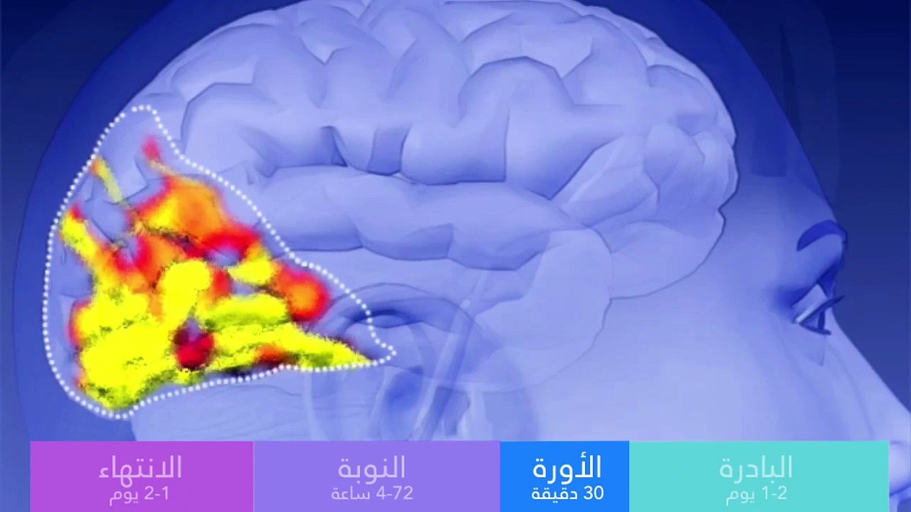 شاهد بالفيديو ماذا يحدث خلال الصداع النصفي مع ا...