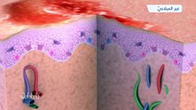 شاهدوا بالفيديو: كيف يتكون سرطان الجلد؟