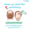 ماذا تعرف عن عملية زراعة الشعر؟