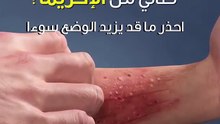 إليك الأكزيما وما يزيدها سوءا