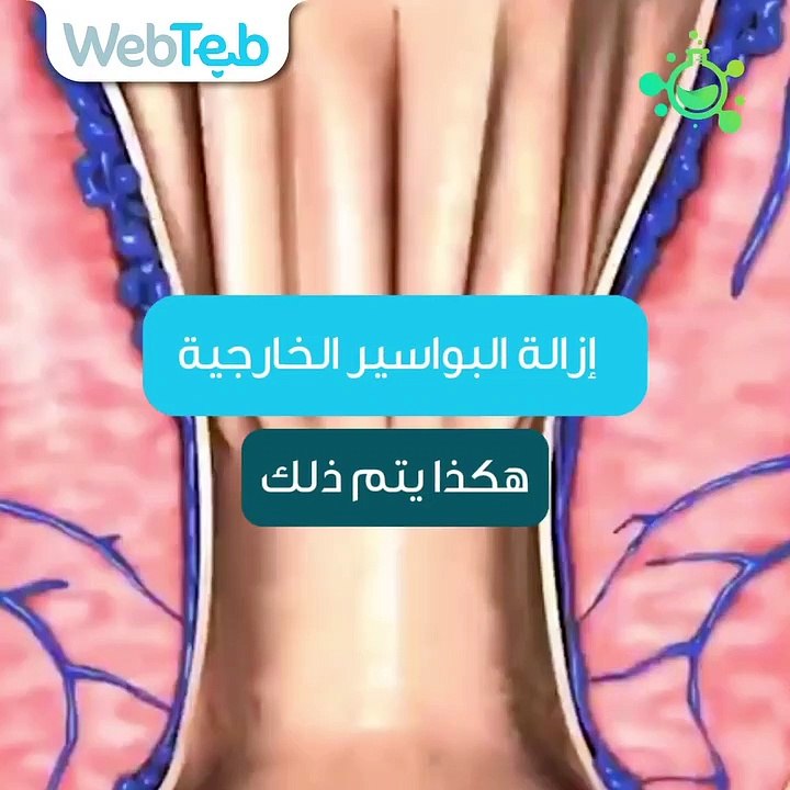 العملية التي تهدف إلى إزالة البواسير الخارجية