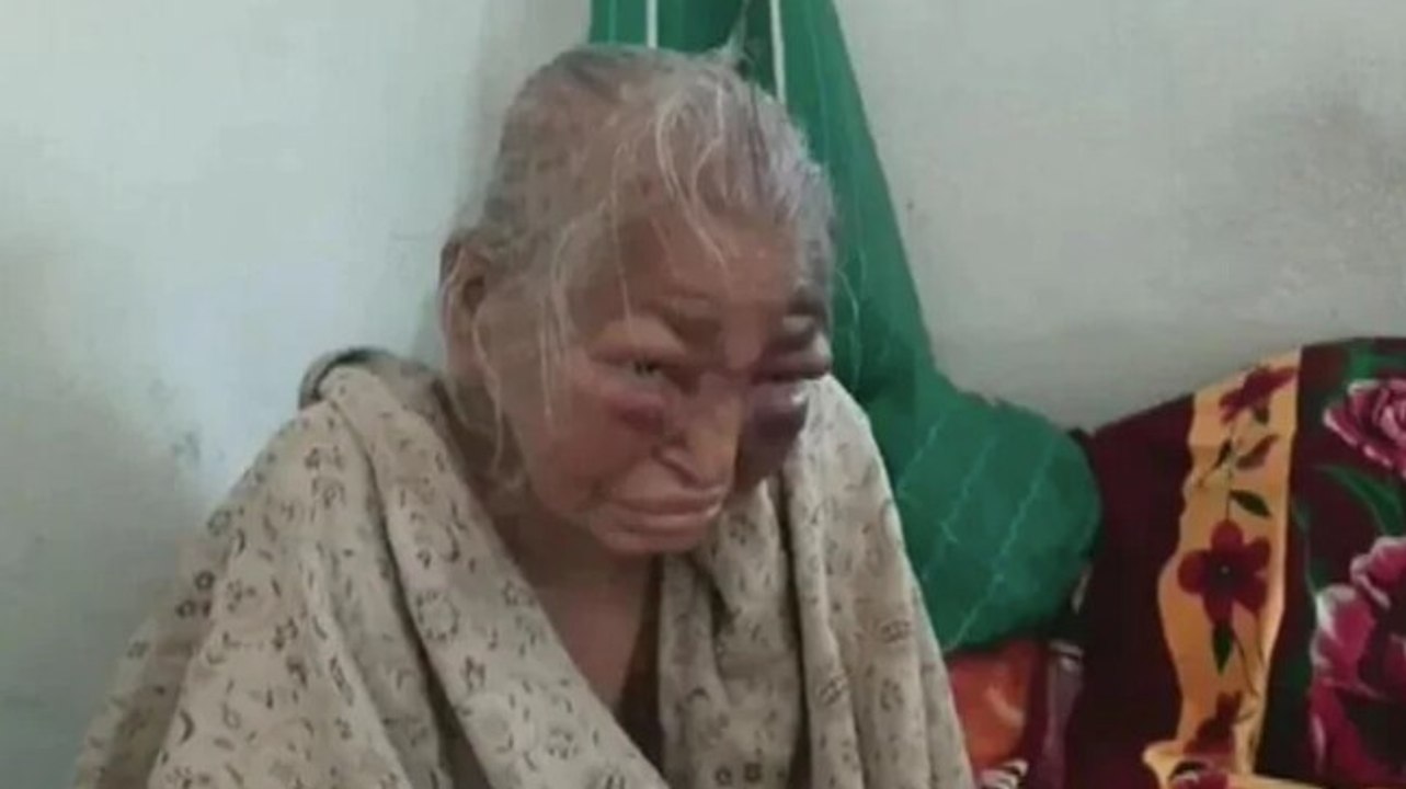 BJP worker's mother who was allegedly beaten by TMC workers dies