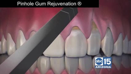 Pinhole Gum Rejuvenation: An easier fix for receding gums
