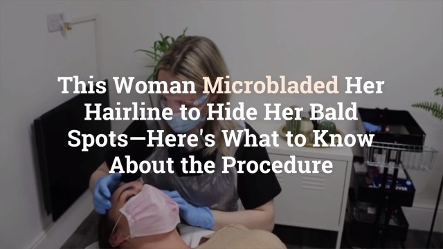 This Woman Microbladed Her Hairline to Hide Her Bald Spots—Here's What to Know About the Procedure