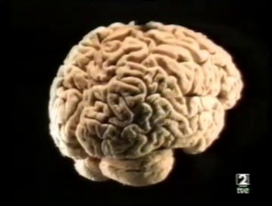 Enfermedad de Creutzfeldt-Jakob (Nueva variante). Mal de las vacas locas