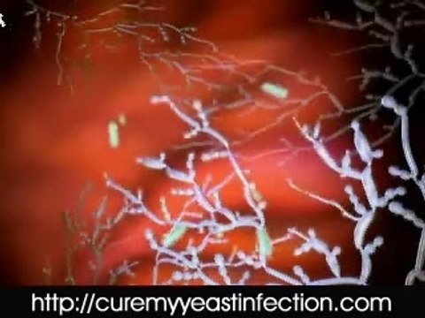 Cure Your Yeast Infection Permanently!